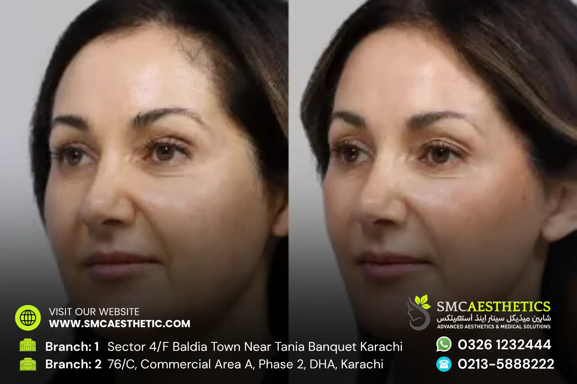 Thread Lift Before and After Results - SMC Aesthetics Karachi