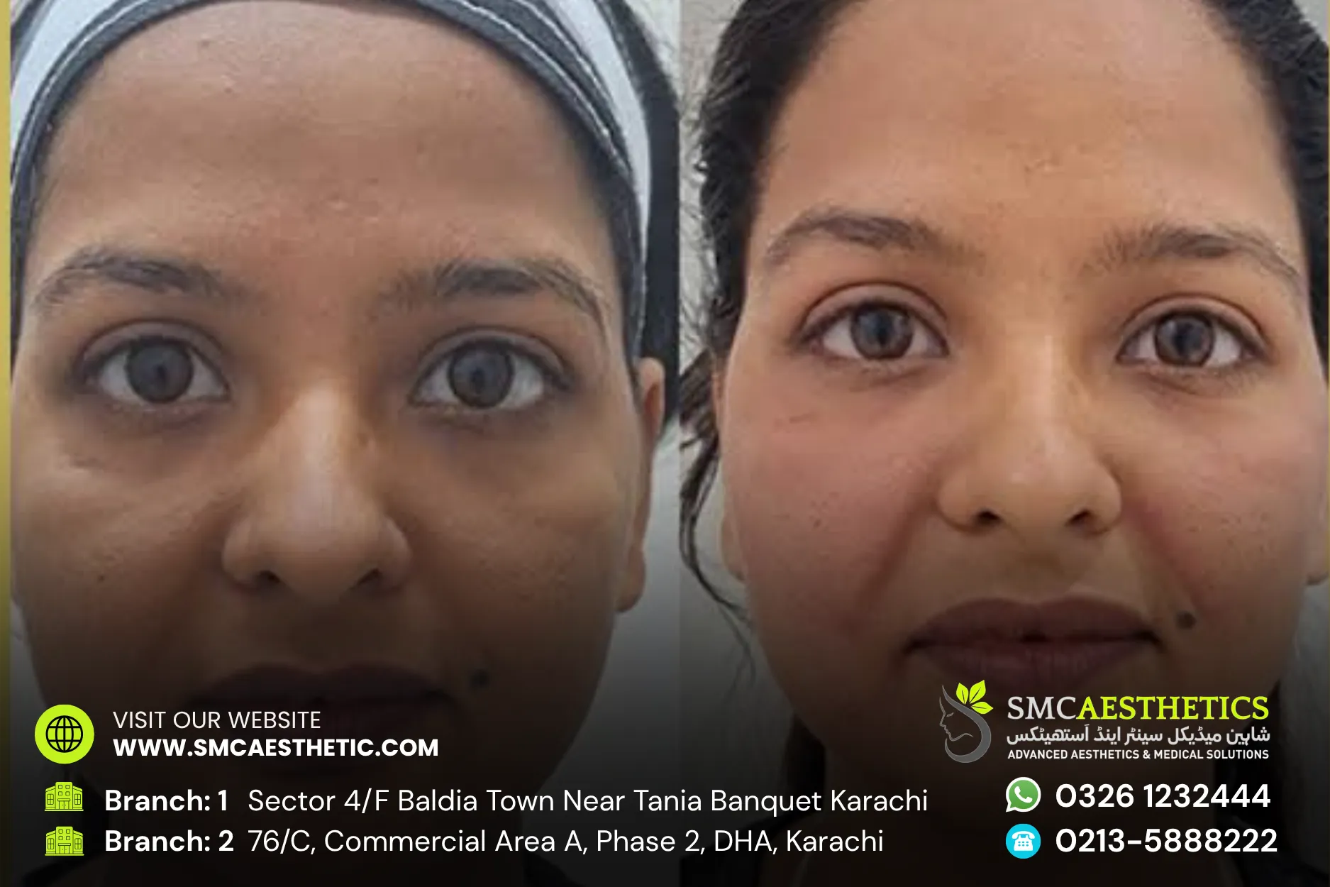 Thread Lift Before and After Results - SMC Aesthetics Karachi