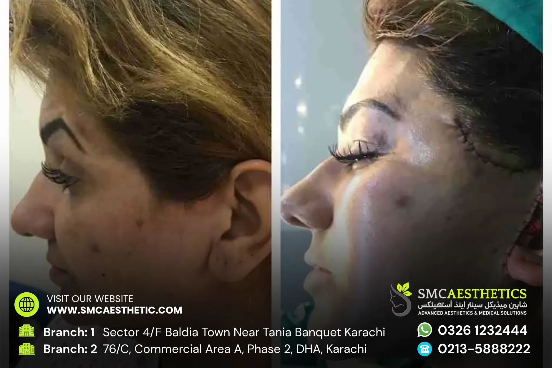 Thread Lift Before and After Results - SMC Aesthetics Karachi