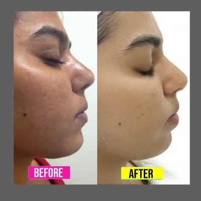 glutathione before after