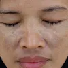 melasma treatment