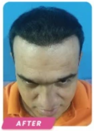 After FUE Hair Transplant