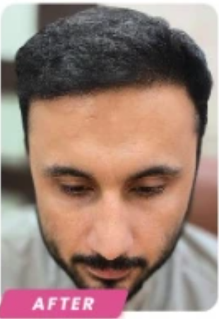 After DHI Hair Transplant