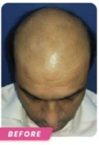 Before Hair Transplant