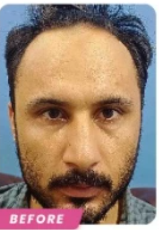 Before Hair Transplant